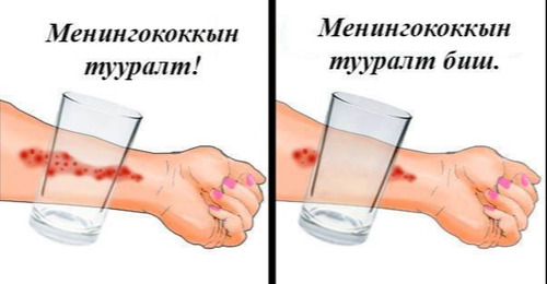 Менингоккокт халдвараар өвчилсөн таван настай хүү нас баржээ